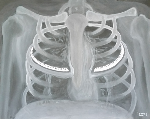 X-ray of chest with piano keys
